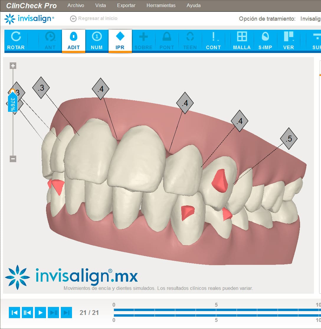 Software-Clincheck-Invisalign