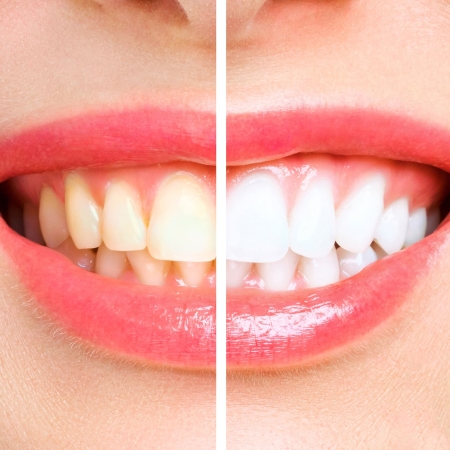 woman teeth before and after whitening. Over white background. Dental clinic patient. Image symbolizes oral care dentistry, stomatology.