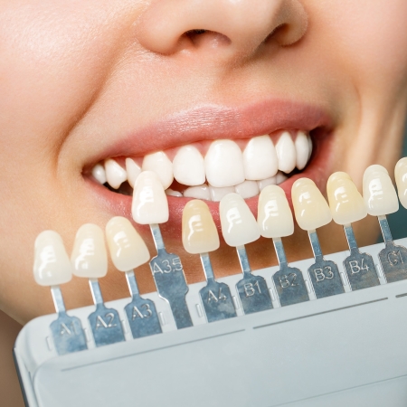 Smiling young woman. Cosmetological teeth whitening in a dental clinic. selection of the tone of the implant tooth.