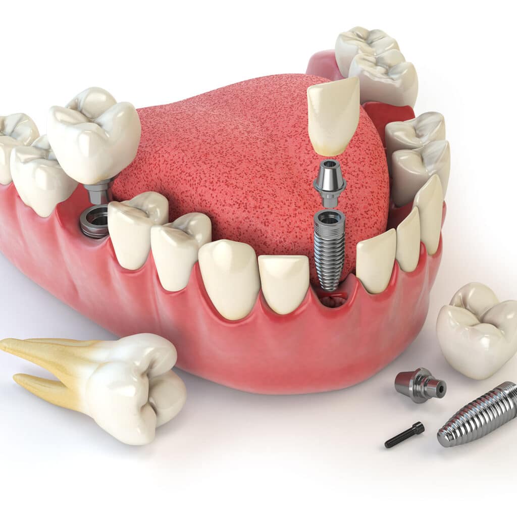 🔩 Implantes con pérdida de hueso en Vélez-Málaga: soluciones cuando falta hueso maxilar 🦴 1 Implantes Dentales