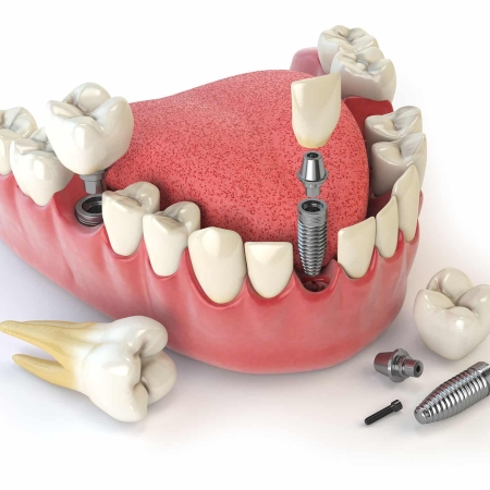 Tooth human implant. Dental concept. Human teeth or dentures. 3d illustration