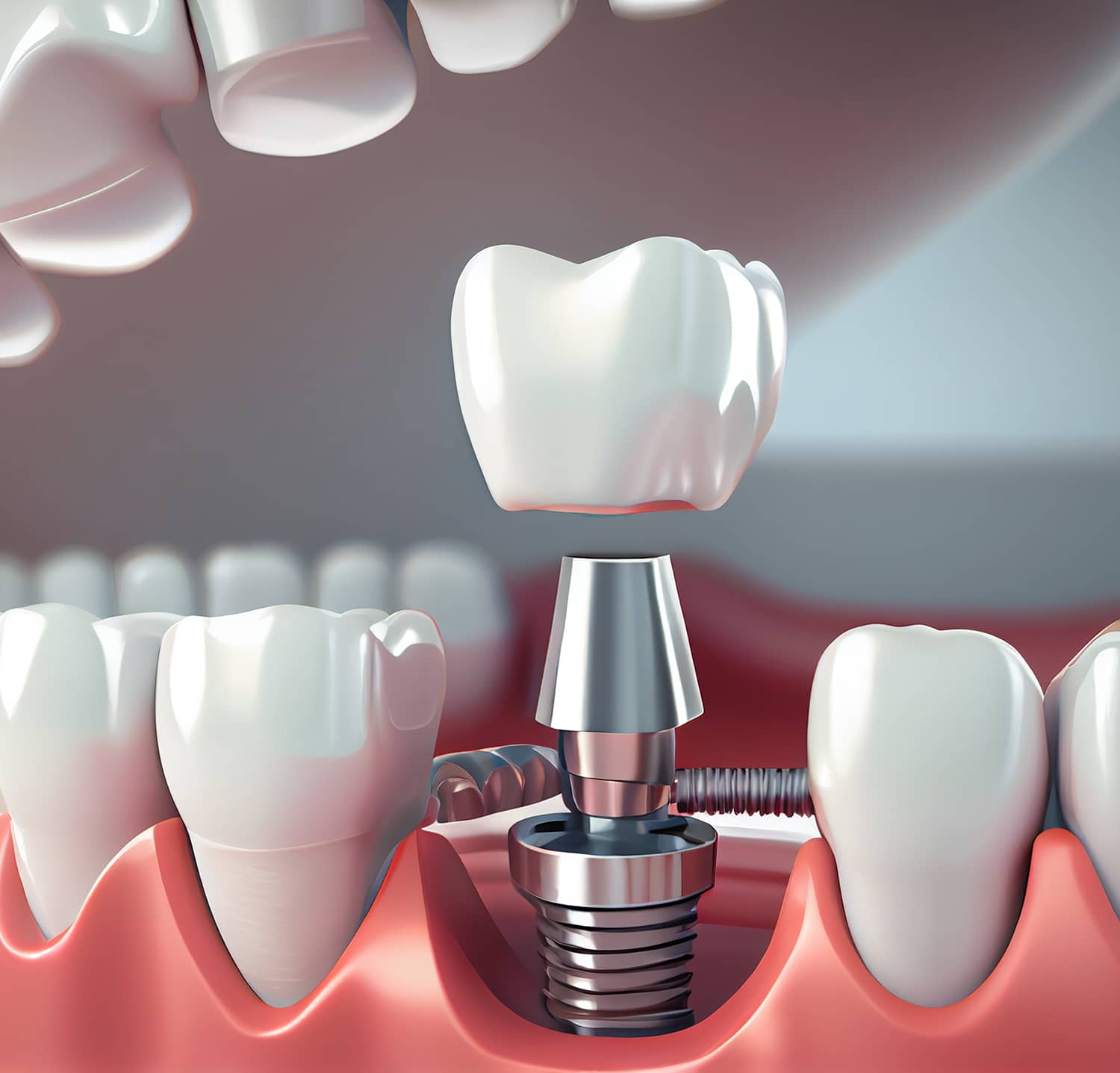 Removable partial denture. Medically accurate tooth.generative ai