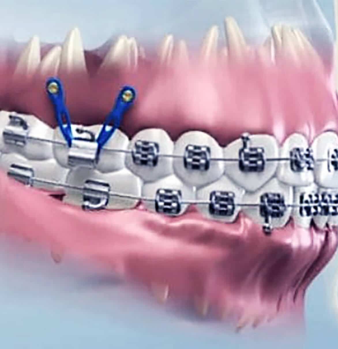 microimplantes-de-ortodoncia
