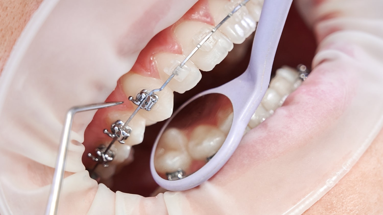 Close up of orthodontist using cofferdam and dental instruments while placing orthodontic brackets on patient teeth. Concept of stomatology, dentistry and orthodontic treatment.
