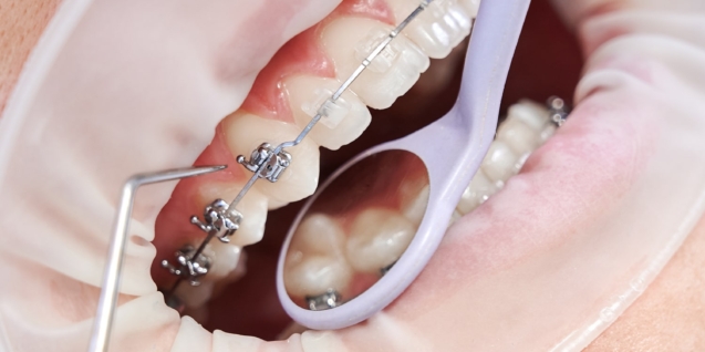 Blog 8 Close up of orthodontist using cofferdam and dental instruments while placing orthodontic brackets on patient teeth. Concept of stomatology, dentistry and orthodontic treatment.