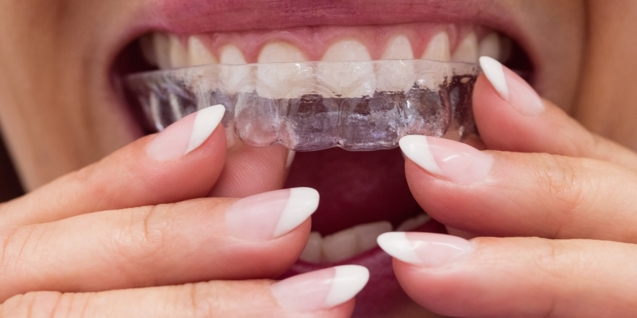 Blog 10 Close-up of female patient wearing braces in dental clinic