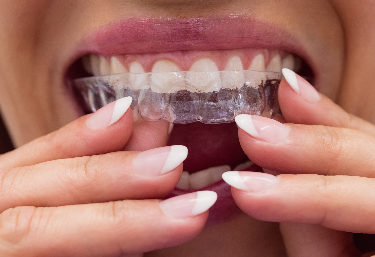 Close-up of female patient wearing braces in dental clinic