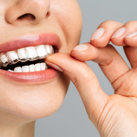 A young woman does a home teeth whitening procedure. Whitening tray with gel.