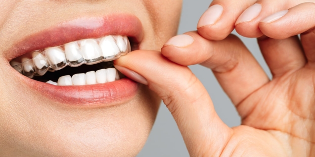 Blog 16 A young woman does a home teeth whitening procedure. Whitening tray with gel.