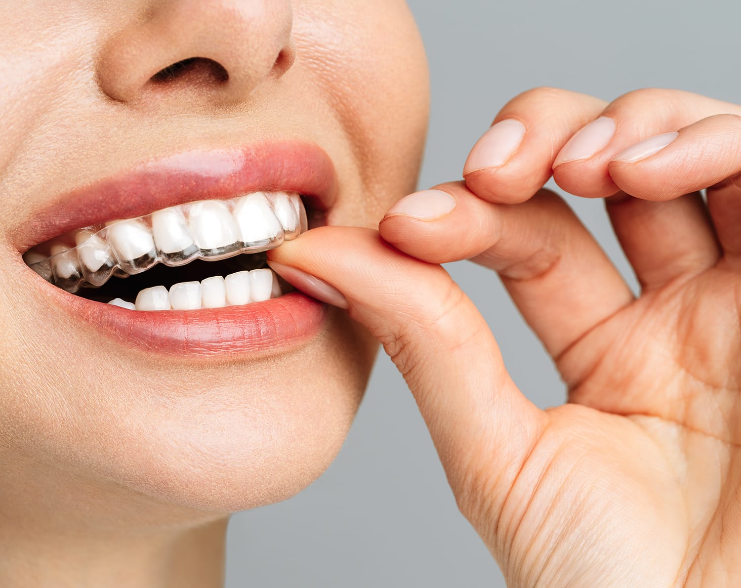 A young woman does a home teeth whitening procedure. Whitening tray with gel.