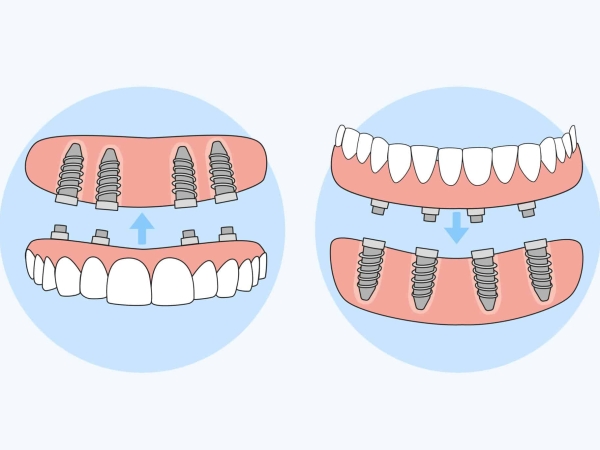 29253752_11_implantedecargainmediata