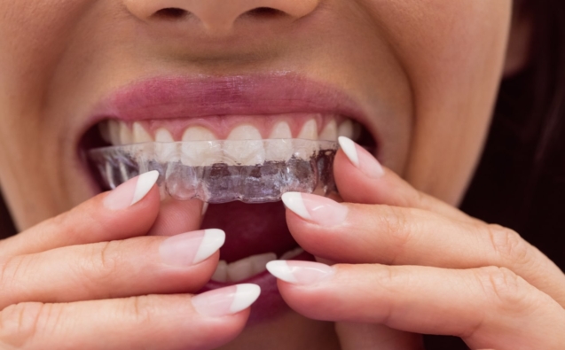 Blog 19 Invisalign