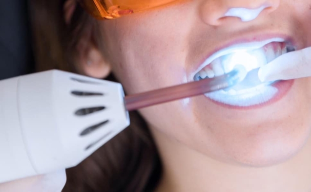 Blog 20 blanqueamientodental