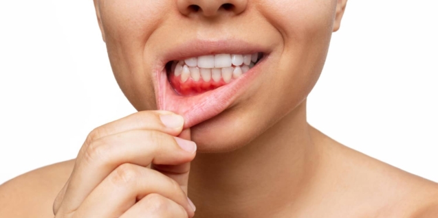 Blog 23 sangrado encias