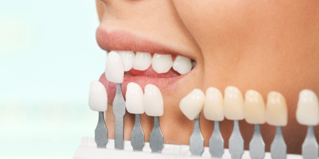 Blog 21 carillasdentales