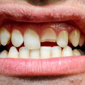 Rotura Dental