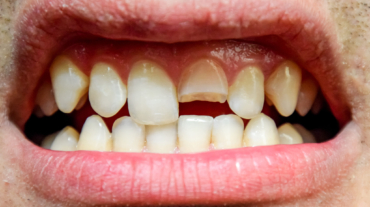 Rotura Dental