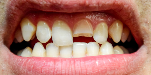 Blog 1 Rotura Dental