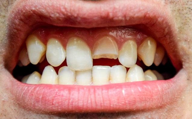 Clinica Dental 4 Rotura Dental